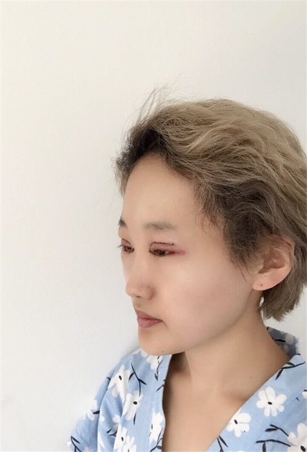 江苏南京施尔美整形美容医院(华东旗舰店)眼部综合样