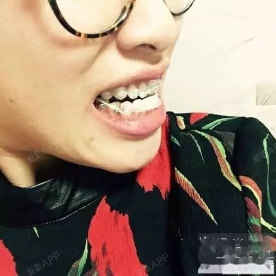 大龄骨性地包天矫正一年了.