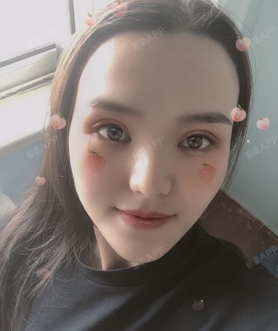 终于摆脱死鱼眼了重睑术一个月分享