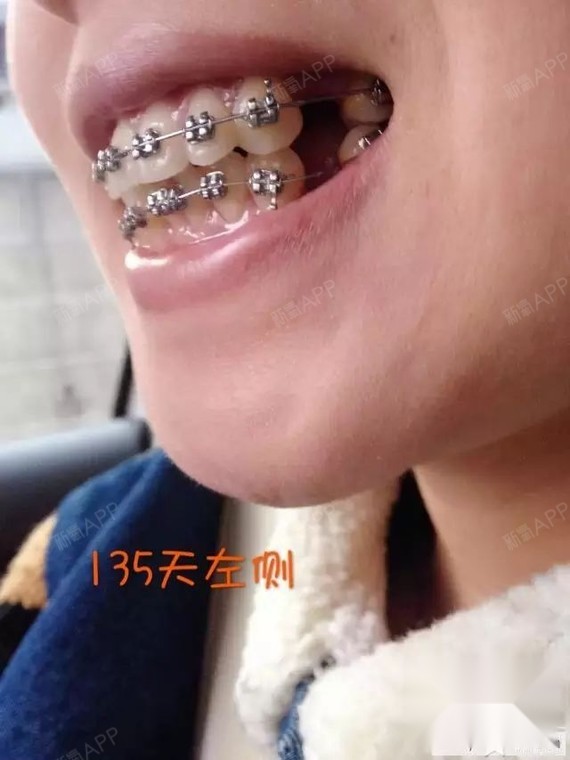骨性 牙性龅牙,两年半结束牙套之旅
