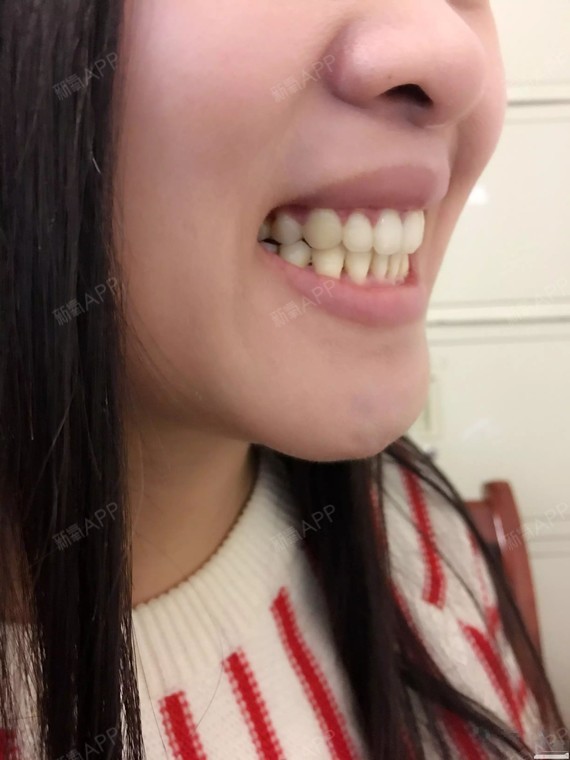 骨性 牙性龅牙,两年半结束牙套之旅