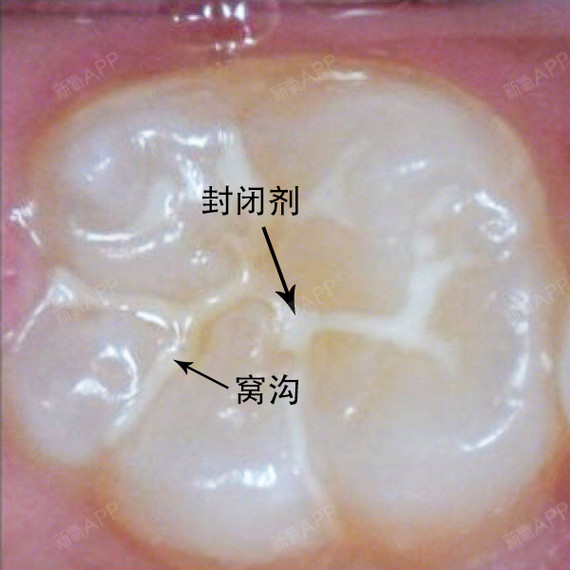 分享一例关于小孩牙齿矫正和窝沟封闭