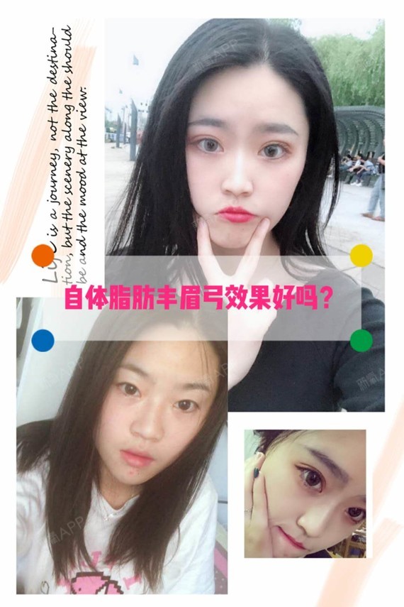 自体脂肪丰眉弓术后效果好么?时间久了脂肪会下垂么?