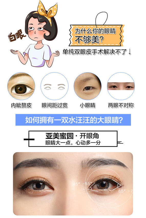 【开内眼角】【国庆hi购】内眼角/外眼角 无张力缝合技术 不回缩 改善