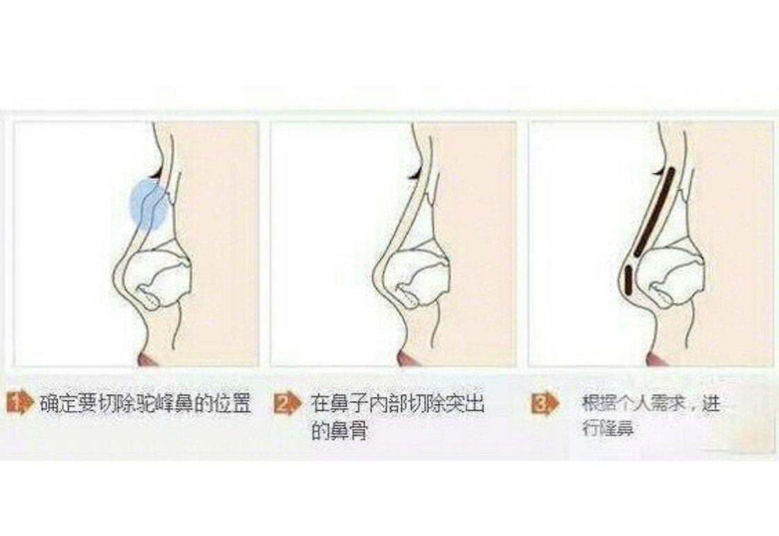 女生有驼峰鼻好难看啊应该怎么做手术才能恢复正常困难吗