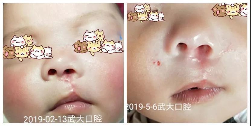 手术疤有救了武汉兔唇宝宝缝合手术后抹它没留疤