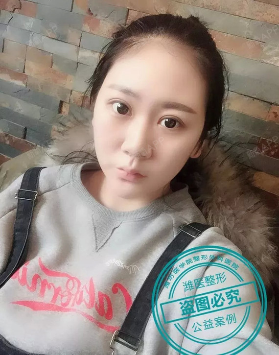 天生双眼皮却还要做双眼皮手术?她们到底怎么了?
