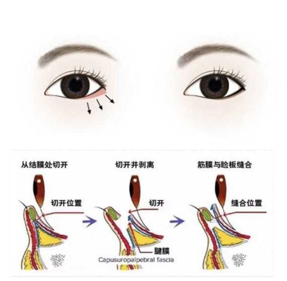 小狗眼术,又称眼睑下至术,是指将下眼睑位置向下调整