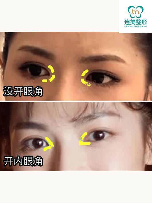 肿眼泡 小眼睛,怎么改善?