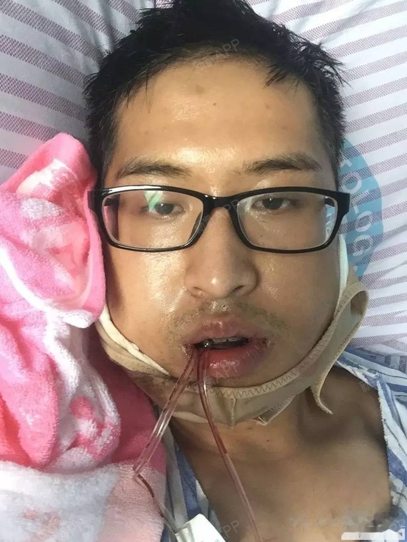 [地包天正颌手术] 27岁男生反颌偏颌华西术后归来17天