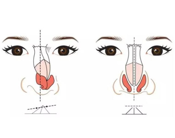关于隆鼻修复你必须知道的事