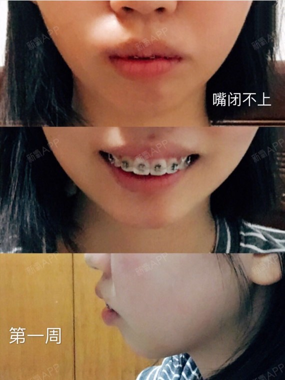 牙齿矫正两年,骨性深覆合,阶段详细对比图.