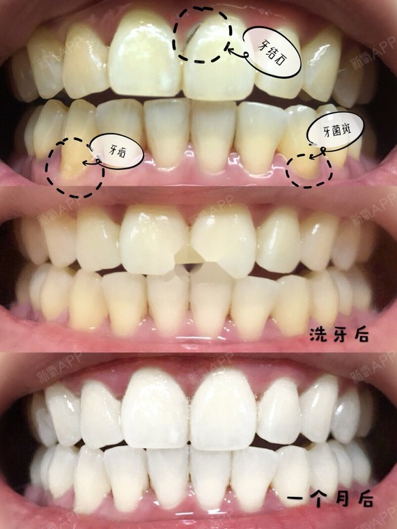 抛光你的牙齿表面而已,本质是不会改变的一般一年建议洗一次牙,洗一次