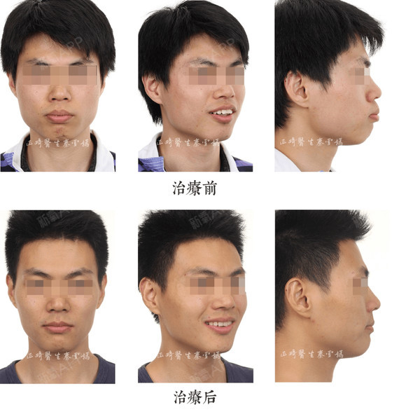 牙齿矫正