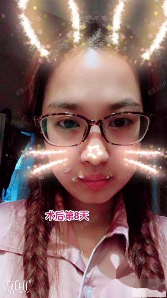 武汉口腔吴中兴 地包天术后28天 变化太大(术前正畸历时2年多牙套)