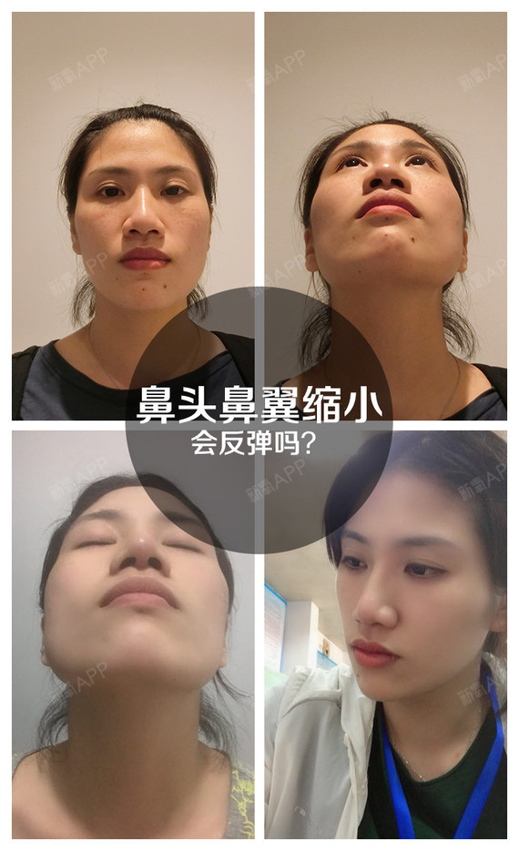 很多小仙女其实鼻子也不低,就是鼻头大鼻翼宽,导致整张脸的气质变得