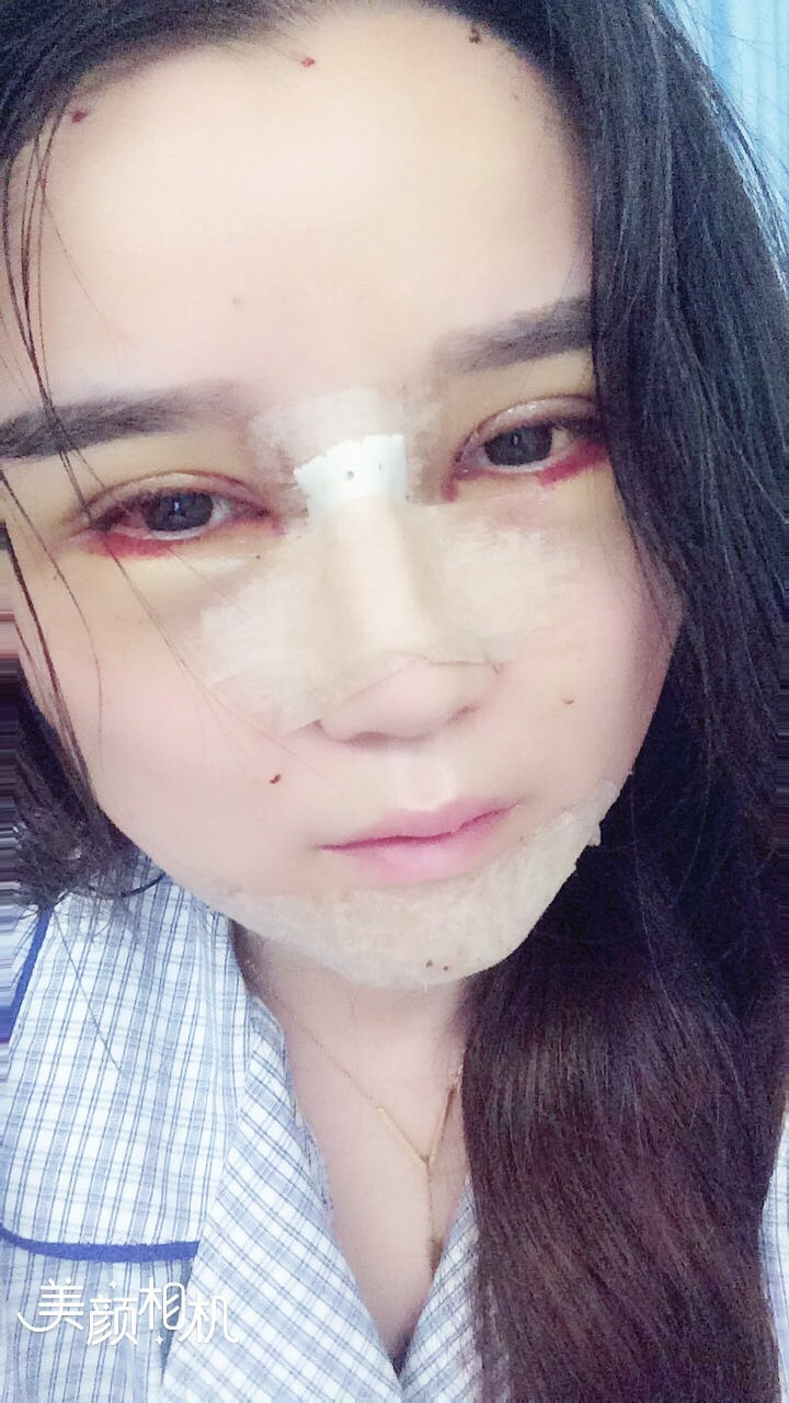 自体脂肪丰眼窝第9天