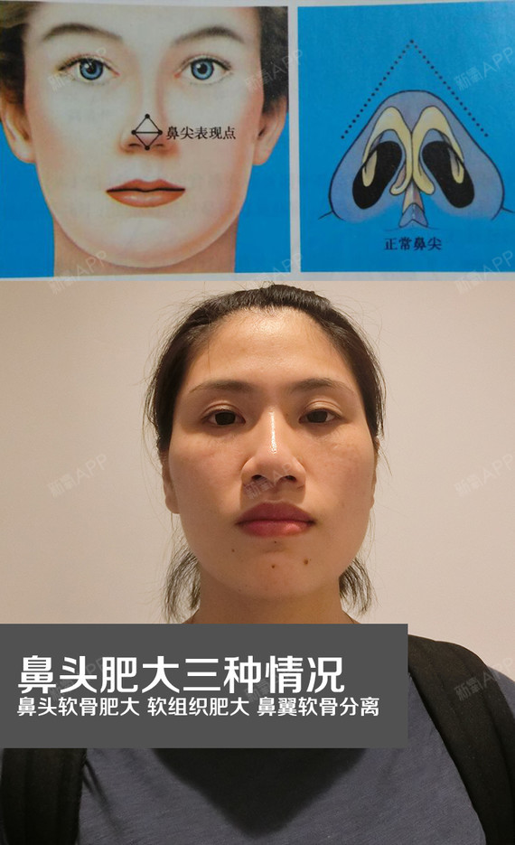 很多小仙女其实鼻子也不低,就是鼻头大鼻翼宽,导致整张脸的气质变得