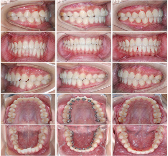 口内照对比也十分明显,牙齿排列整齐美观,咬合稳定.