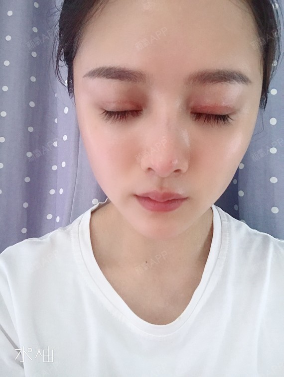 【真人案例--圣嘉新切开双眼皮】