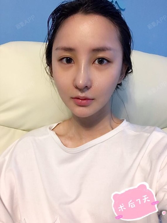【隆鼻假体取出后鼻子会变形吗?】