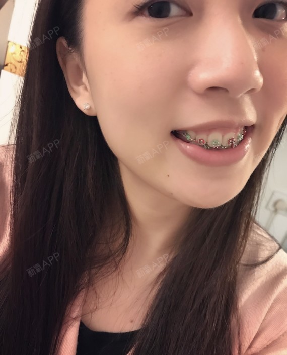 25岁女孩的牙套日记