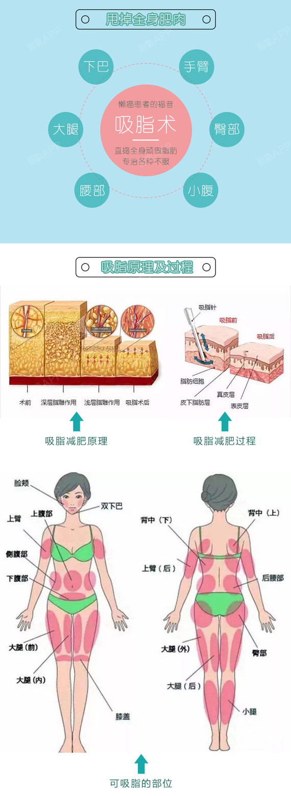 【吸脂】【负压吸脂】改善局部/多部脂肪 维持迷人身材