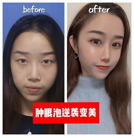杭州探店|双眼皮拯救我的肿眼泡~一直觉得自己眼睛是_圈子-新氧美容