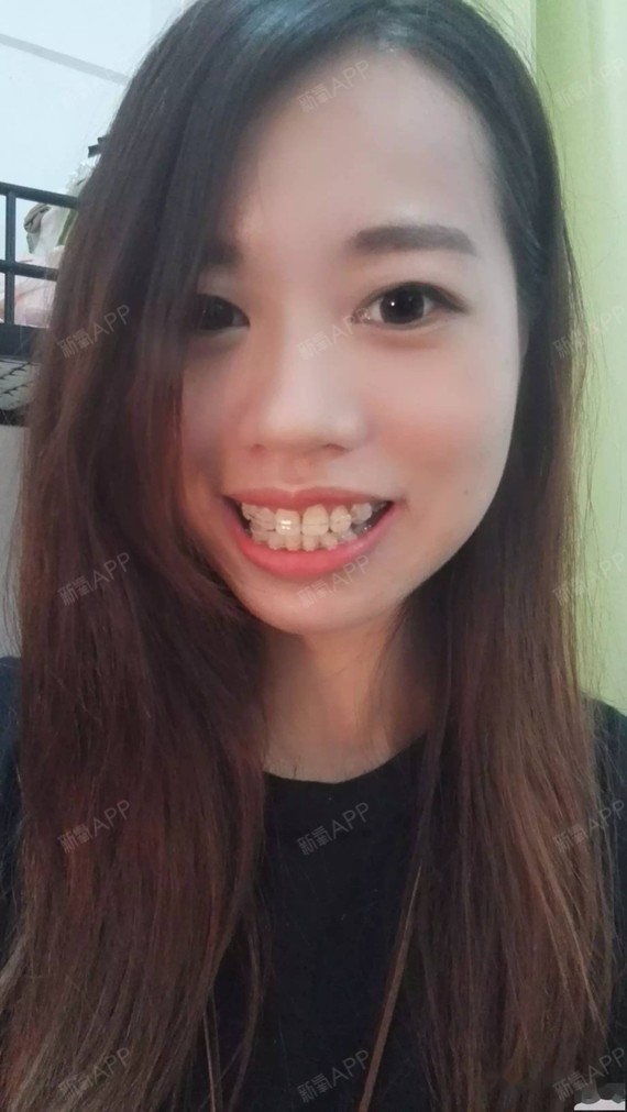 感谢某女星,86年龄单身汪骨性龅牙牙齿矫正