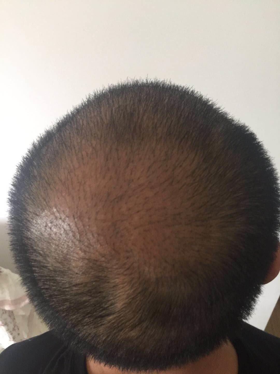 这是一个月多月的时候,头发长的特别好,都说一个月就会进入脱落期,我