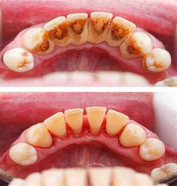 从齿开始,未来可期#为什么医生建议我,洗牙,洗牙,赶紧洗牙