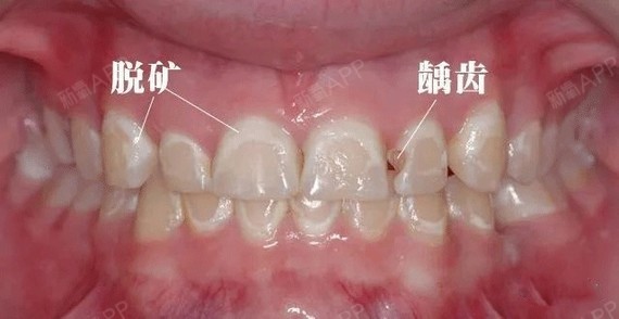 牙齿脱矿是指人的牙齿牙釉质表面的钙磷脱落,因而使牙_圈子-新氧美容