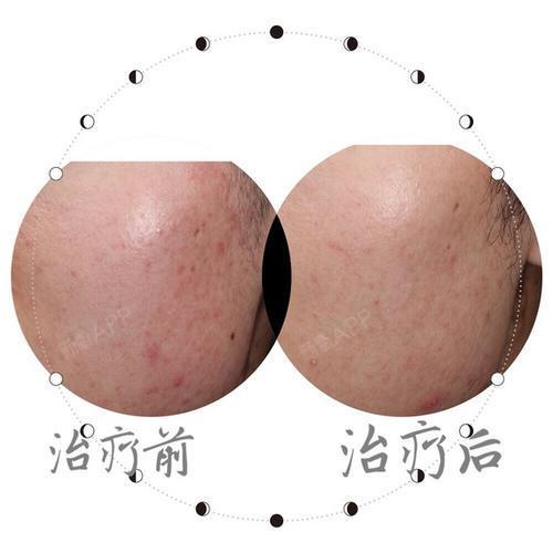 万年大痘坑,我到底应该怎么治好我的脸?