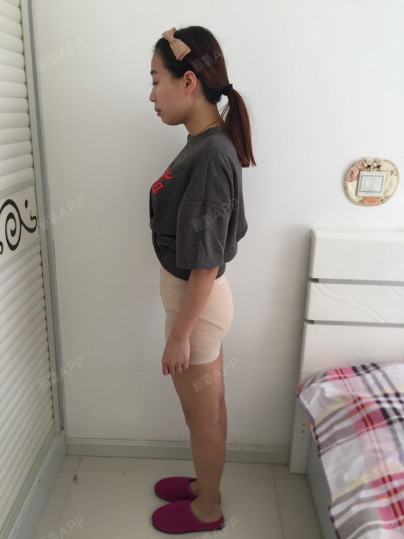 臀部吸脂