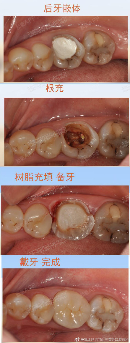 深圳世纪河山口腔真人案例后牙根管治疗后的树脂高嵌体修复
