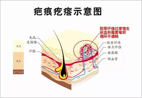 1,具有瘢痕体质的人,在皮肤受到创伤后,会一直生长,部分会长成或融合