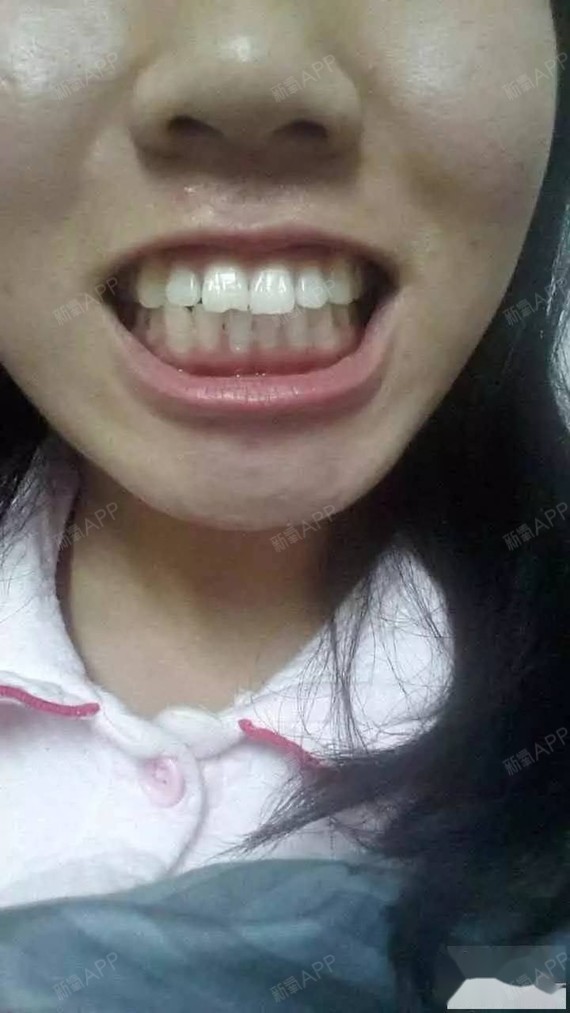 家里不同意我弄牙齿,因为他们觉得只有牙齿乱七八糟的才有必要带牙套