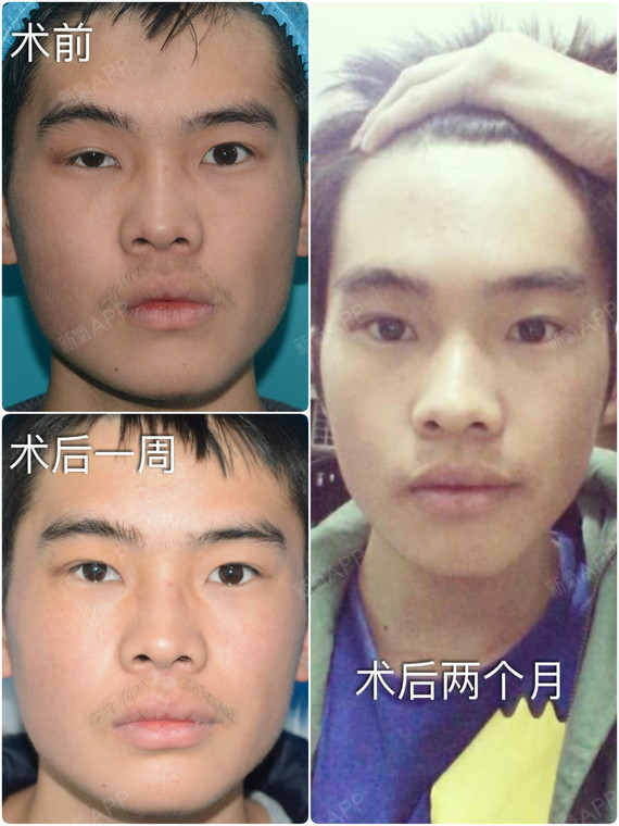 上睑提肌