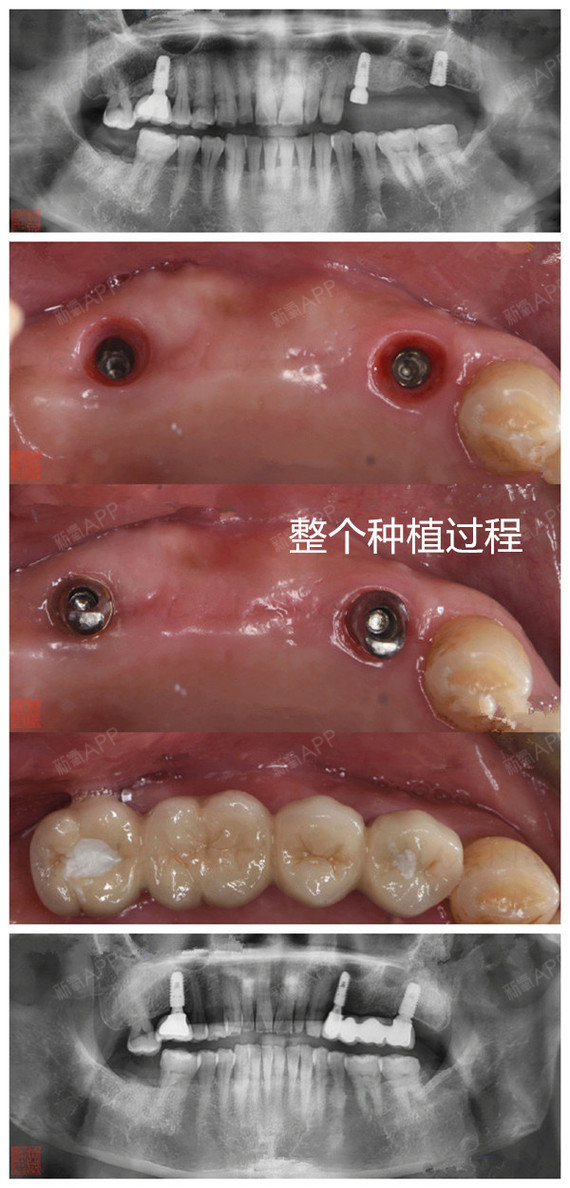 种植牙提醒您:一颗都不能少,一口牙就要整整齐齐