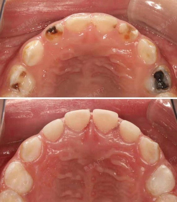 牙齿有洞,补牙or根管治疗?