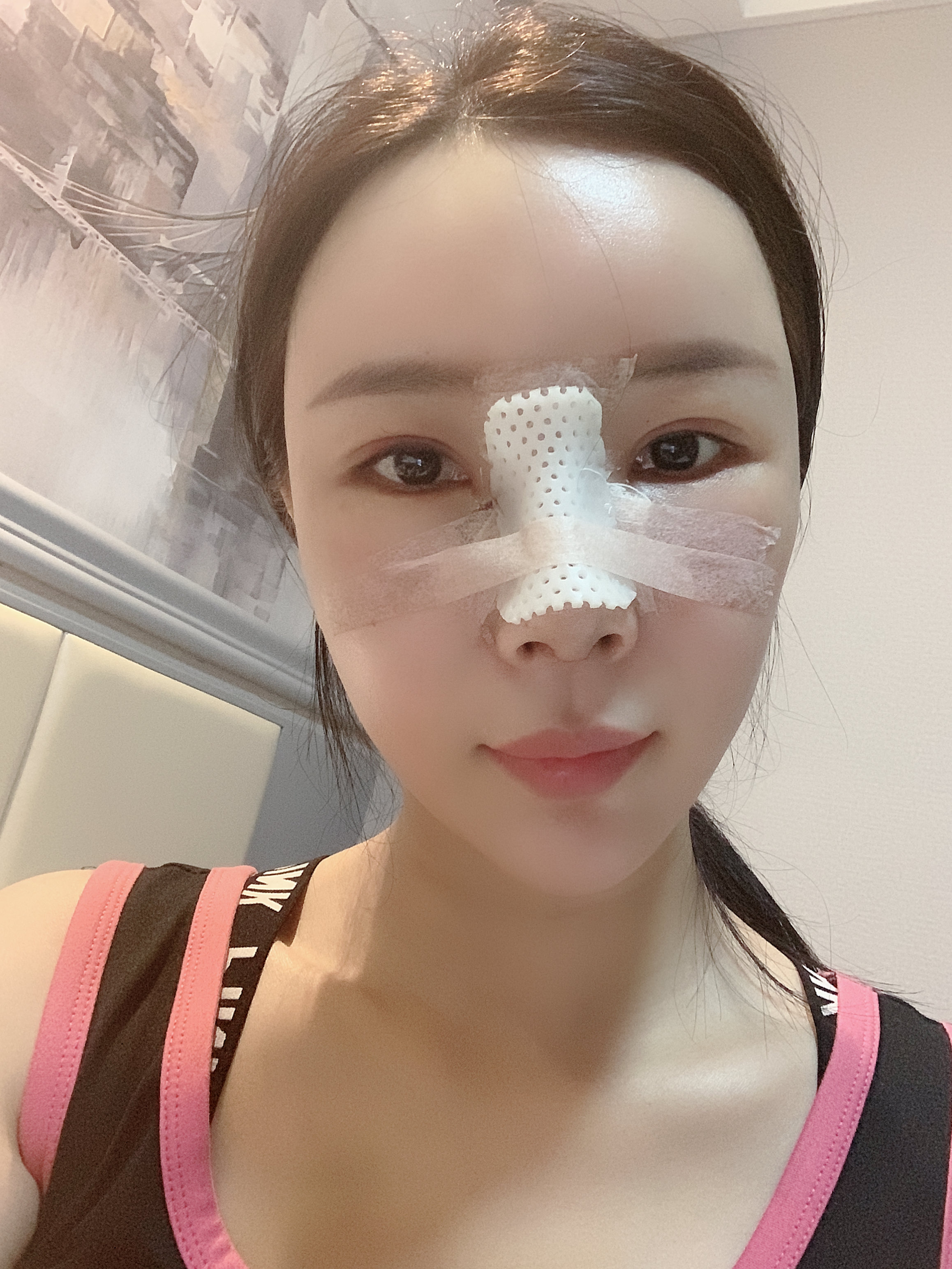 肋软骨隆鼻第3天