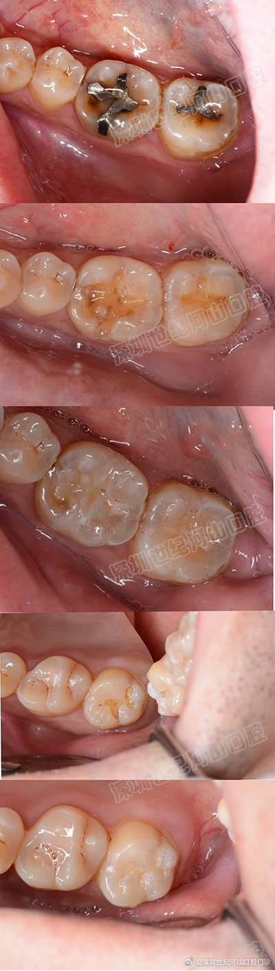 深圳世纪河山口腔真人案例 纳米树脂补牙3mp60 树脂充填