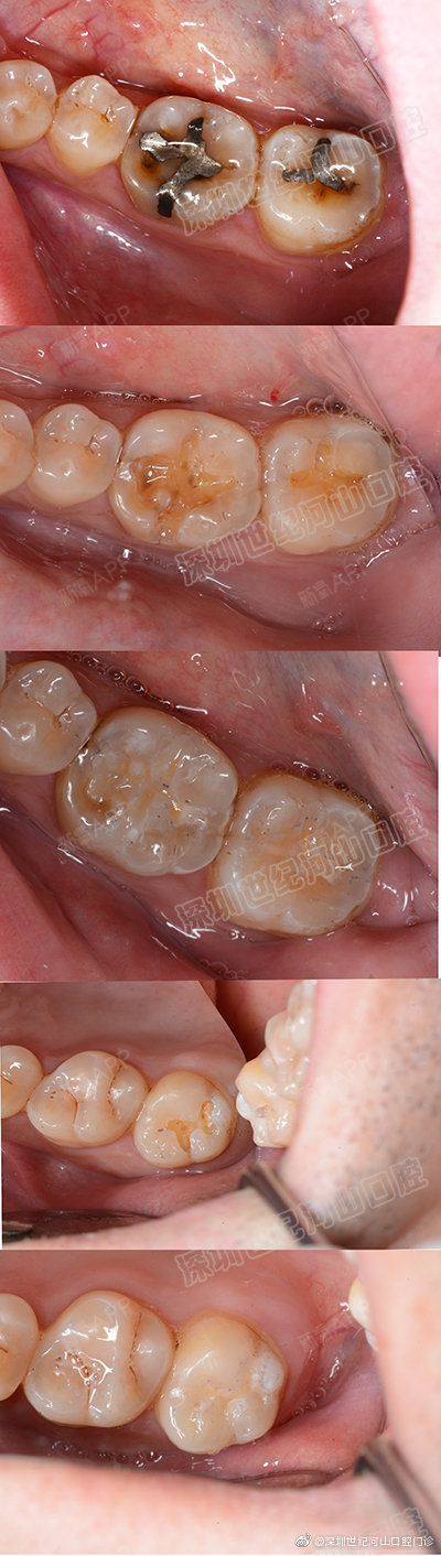 深圳世纪河山口腔真人案例# 纳米树脂补牙3mp60 树脂充填
