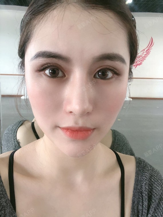 肋软骨隆鼻