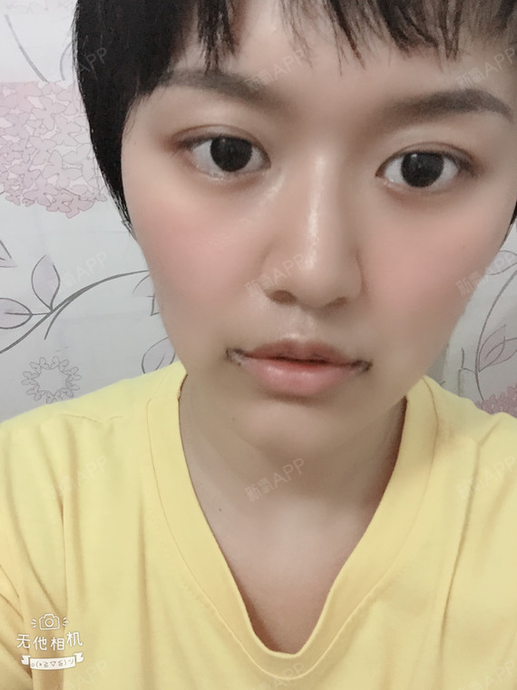 这两天嘴唇稍微消肿了,看起来就没那么吓人了,唇形也看得出了.