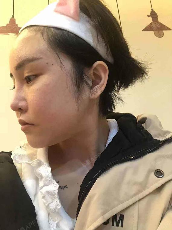 下颌角整形好不好