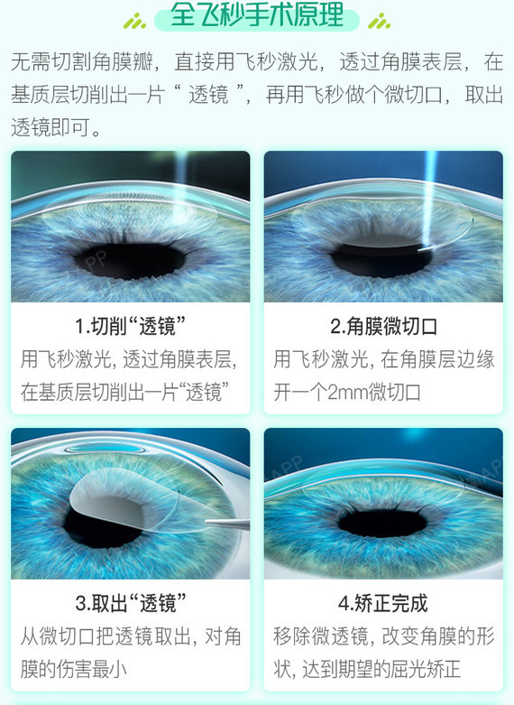 【全飞秒激光术】德国蔡司visumax3.