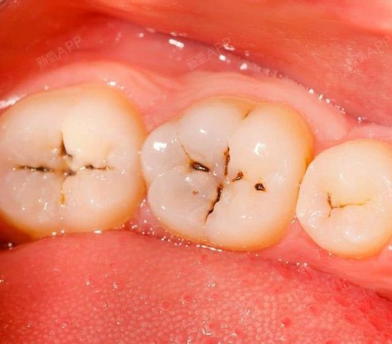 牙齿上出现小黑点有两种情况:一是色素沉着,二是蛀牙.