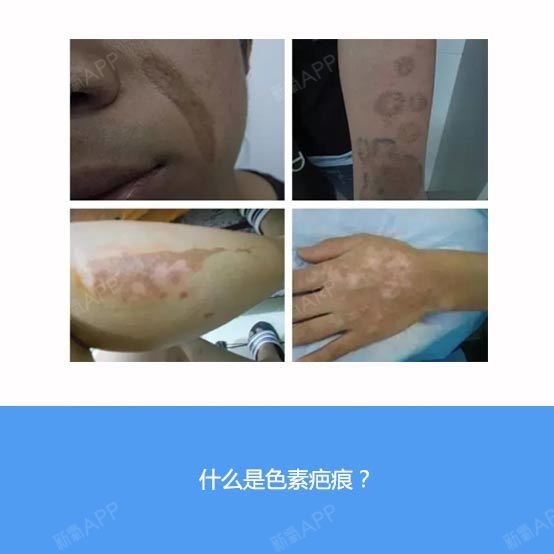 疤痕色素沉着是疤痕中常见的一种,有些人受伤后,伤口