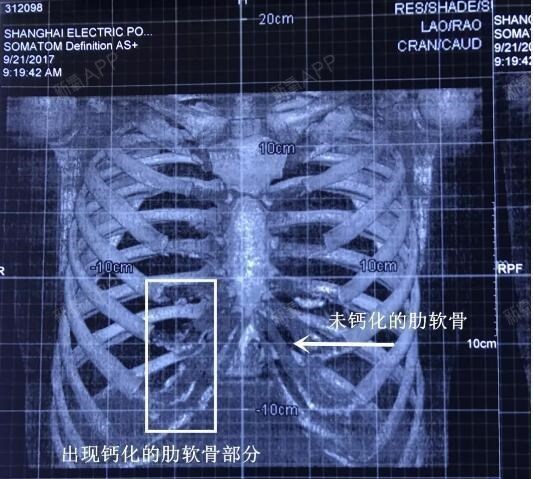 肋软骨钙化了怎么回事?要怎么做鼻综合整形?